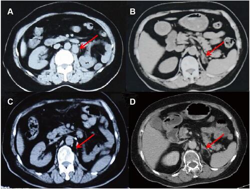 Figure 2 Abdomen CT scans after 6 months chemotherapy with cisplatin and gemcitabine (A and B) and after 6 cycles of immunotherapy with pembrolizumab (C and D), images on the same sections. (A) Compared with Figure 1A, the patient’s left abdominal aortic lymphadenopathy was enlarged (red arrow). (B) The left main adrenal gland and medial branch nodules were thickened (red arrow), suggesting that the tumor has metastasized. (C) Abdominal aortic lymph node enlargement shrank significantly (red arrow). (D) The left main adrenal nodule disappeared (red arrow), indicating the stabilization of disease progression.