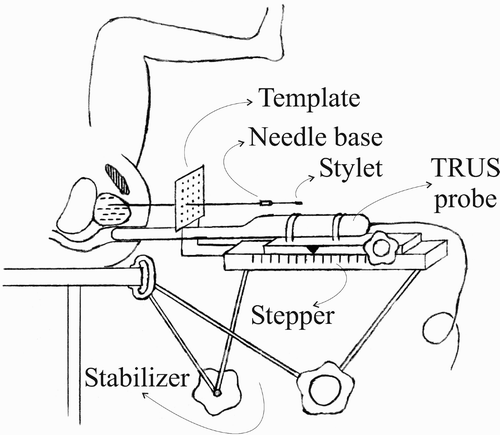 Figure 1. A conceptual overview of the brachytherapy procedure