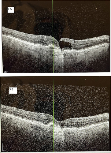 Figure 3 A 76-year-old male with neovascular age-related macular degeneration and persistent macular fluid, despite 11 aflibercept injections during the previous 12 months and a total of 35 anti-VEGF treatments over the previous 3 years. The vertical line (green) in each image orients the reader to the same position in the macula between images. (A) Optical coherence tomography image at baseline demonstrates diffuse intraretinal macular fluid. Central macular thickness was 340 µm and Snellen visual acuity was 20/100. (B) Optical coherence tomography image of the same subject after switching from aflibercept to faricumab and receiving seven faricumab treatments over 12 months. Central macular thickness decreased to 268 µm and Snellen visual acuity improved to 20/60. The intraretinal macular edema is notably reduced from baseline, and now is only a trace amount. The subject was able to be extended to a 7-week treatment interval at the end of the 12-month study period.