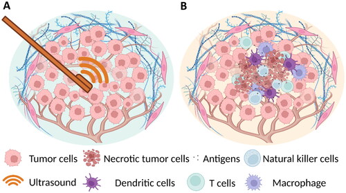 Figure 3. Schematic of intratumoral histotripsy immunotherapy. (A) Intratumoral sonication using an intracorporal, miniaturized ultrasound device. (B) Histotripsy-induced tumor cell necrosis and corresponding immunomodulation. Created with biorender.com.