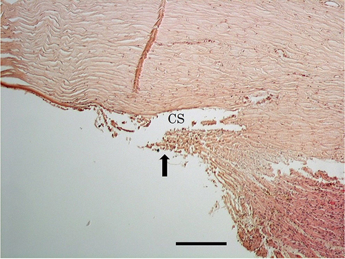 Figure 4 Goniotomy with the SION device both incised and excised trabecular meshwork (arrow), with instances of incision predominating over instances of excision. Residual leaflets varied from 50–150 µm. H&E stained sections, scale bar = 200 µm.