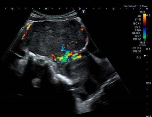 Figure 1 Longitudinal view of the uterus with a single 12 cm subserosal fibroid on transabdominal ultrasound scan. Feeder pedicle vessels are demonstrated on Doppler examination.