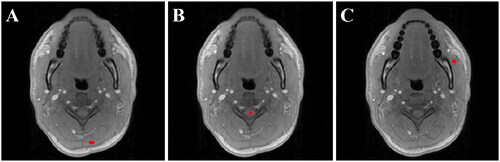 Figure 1. Example of position and size of ROIs selected for volunteer MRT performance analysis. From left to right: (A) neck muscle, (B) spinal cord, and (C) masseter muscle.