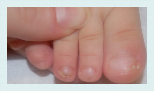 Figure 10. Nail psoriasis of the third right toenail.Onycholysis with erythematous border and splinter hemorrhages.