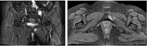 Figure 5 After 12 weeks of oral fluconazole treatment, the pubic lesions basically disappeared.