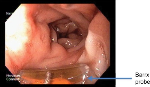 Figure 2 Patient after second ablation with radiofrequency ablation with Barrx probe (case 1).