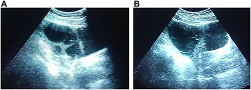 Figure 2 (A) Right ovary sagittal ultrasound image shows enlarged right ovary with multiple cysts of various size consistent with ovarian hyperstimulation. (B) Left ovary sagittal ultrasound image shows enlarged left ovary with multiple cysts of various size consistent with ovarian hyperstimulation.