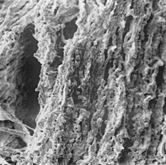 Figure 2 Small cavities (clefts) lined by normal or fragmented elastic fibers, ×550.