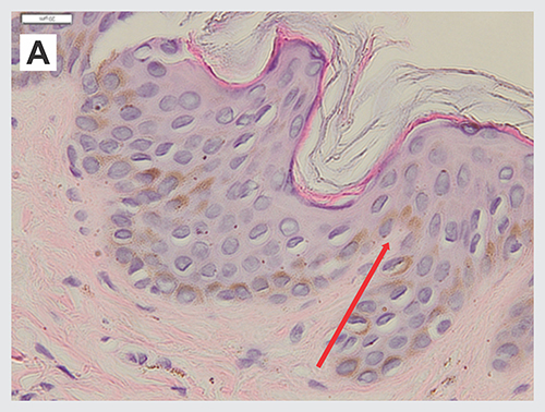 Figure 2 Histopathological examination from hyperpigmented macules on right arm showed melanocytes deposition on basal layer of epidermis.