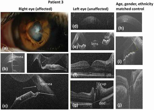 Figure 4. Anterior segment photography (A) and spectral domain optical coherence tomography (B–J) of case 3 with right Peter’s anomaly (case 3; A–C = affected eye, D–G = unaffected eye) and a healthy control (H–J). Slit-lamp photography (A) shows central corneal opacity with iridocorneal adhesion. The white arrows on figure B show iridocorneal adhesion on anterior OCT. On figure C, the dotted arrow indicates the scleral spur and the white arrow shows thinning of the iris root. Due to lens opacity in the right (affected) eye, posterior OCT was not possible. The horizontal lines on figures G and J connecting the edges of retinal pigment epithelium show the disc diameter. Optical coherence tomography (OCT) of the left (unaffected) eye of the patient with Peter’s anomaly showed normal anterior segment structures (D, E) and macula (F) with small optic nerve cup (G) as compared to the control subject (J). Reprinted with permission from [Citation63], licensed under https://creativecommons.org/licenses/by/4.0/.