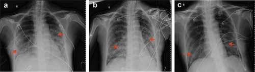 Figure 4 The chest X-ray films of the patient during PJP treatment. (a) On day 11, bilateral lung texture increased and blurred, and scattered patchy shadows (red arrow) in the left middle and lower lobe plus right lower lobe 7 days after oral sulfamethoxazole-trimethoprim (TMP-SMX) treatment; (b) On day 16, patchy shadows of bilateral lung (red arrow) were not changed 12 days after oral TMP-SMX treatment; (c) On day 17, patchy shadows of bilateral lung (red arrow) were absorbed 2 days after intravenous TMP-SMX treatment.