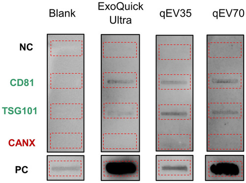 Figure 3 Representatives of immunoaffinity blotting for typical EV marker expression (12.5 μg protein loading). The EV samples from PCa patients showed the presence of CD81, TSG101 markers and absence of Calnexin (CANX) marker. Blank: assay running with PBS instead of sample. The red dotted boxes highlighted the location of individual blots.