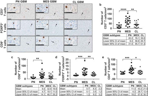 Figure 3. T cells preferentially infiltrate MES GBM. (a) Representative images depicting infiltrated CD3+, FOXP3+ and CD8+ T cells (arrows) in different GBM subtypes. Scale bars indicate a length of 100 micrometers and 50 micrometers (inserted images). (b) Quantification of the number of CD3+ cells reveals a higher density in MES GBM, with CD3 staining all T cells. (c) Infiltration of CD8+ T cells differs significantly between the PN and MES subtypes. CD8+ T cell numbers were also higher in MES than CL tumors, but not significantly (p = .08). (d, e) Dot plots demonstrating FOXP3+ and CD4+ T cells appear in significantly higher numbers in MES GBM. PN and CL GBM show similar levels of infiltration. The average of each tumor is represented by one data point.