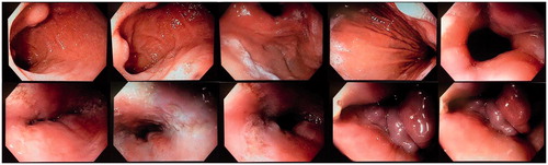 Figure 1. Esophagogastroduodenoscopy with of abnormal-appearing ulcerations in the lower esophagus and a lobulated, edematous abnormal-appearing epiglottis.