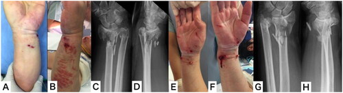 Figure 1. Appearance and plain x-ray on arrival at the emergency department. (A,B) Appearance of the left wrist; (C,D) plain x-ray of the left wrist; (E,F) appearance of the right wrist; (G,H) plain x-ray of the right wrist.