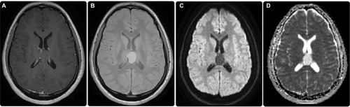 Figure 3 Post-contrast images showing no enhancement (A). Gradient images indicating no blooming artifacts to suggest hemorrhage or calcification (B). No diffusion restriction was elicited in diffusion-weighted imaging (DWI) (C)/apparent diffusion coefficient (ADC) (D) sequences.