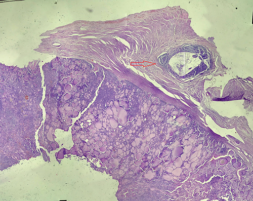 Figure 6 Microscopic view of appendiceal mass with apparent metastatic thyroid tissue that has pushed the appendiceal mucosa (arrow).