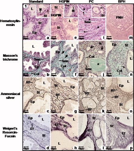 Figure 1.  Photomicrographs of the prostatic peripheral zone from standard (a, b, c, d), HGPIN (e, f, g, h), PC (i, j, k, l) and BPH (m, n, o, p) groups. (a) Epithelium with secretory columnar and basal cells; inset: secretory epithelial cell nucleus (N), basal cells (arrow) with flattened nuclei. (b) Thin collagen fibres (Col) underlying the epithelium and among smooth muscle cells. (c), (d) Reticular (Rf) and elastic (EF) fibres underlying the epithelium. (e) HGPIN; inset: HGPIN focus, voluminous cellular nuclei (N) and basal cells (arrow). (f) Secretory epithelium with HGPIN foci (arrows), increased collagen fibres (Col) and smooth muscle cells. (g), (h) Increased reticular (Rf) and elastic (Ef) fibres. (i) Peaked neoplastic acini (asterisks) with infiltrative feature, periacinar space (arrows); Irregular smooth muscle cells; inset: neoplastic acini with increased nuclei (arrow). (j) Neoplastic acini (arrows); Increased collagen fibres (Col), smooth muscle fibres, amylaceous body (asterisk) and inflammatory cells (Ic). (k), (l) Disorganised and increased reticular (Rf) and elastic (Ef) fibres. (m) BPH with acinus showing an external straight line and internal papillomatosis. (n) Epithelium with secretory columnar and basal cells (arrow); hypercellular stroma with increased collagen fibres (Col). (o), (p) Hyper-plastic stroma with increased reticular (Rf) and elastic (Ef) fibres. a–p: Ep, epithelium, L, lumen, Smc, smooth muscle cell and St, stroma.