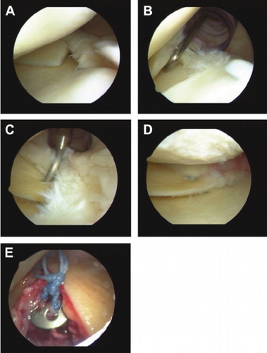 Figure 6. Steps taken during arthroscopic repair of the posterior medial meniscus radial root (left knee). A. Radial root tear. B. Probing of root tear through posteromedial knee portal cannula. C. Placement of shuttle suture device through body of root tear. D. Transosseous pullout repair of root tear. E. Pullout sutures tied over a button on the anteromedial tibia. Reprinted with permission from Bhatia et al. (Citation2014).