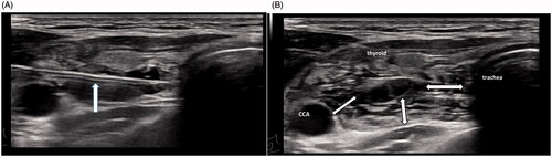 Figure 3. Ultrasonography of parathyroid isolation fluid. (A) The isolation needle was placed between the parathyroid gland and the trachea, then the isolation fluid was injected to widen the space between the parathyroid gland and the trachea. (B) The isolation band between the parathyroid gland and the surrounding should be >1 cm, so that the parathyroid gland can exist as a solitary island.
