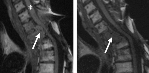 Figure 5.  Minor response in a patient with hormonally active, metastasised paraganglioma after treatment with [177Lu-DOTA0,Tyr3]octreotate. Left panel: Vertebral metastasis (arrow) compressed the spinal cord (*) before treatment. Right panel: Tumour size regresssion (arrow). Spinal cord compression was not present anymore after the treatment. Paraesthesia in the left arm decreased, but a mild paresis of that arm persisted. Moreover, the patient was able to walk better and anti-hypertensive medication could be decreased.