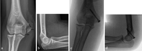 Figure 3. a, b. 12.6-year-old gymnast's 8 mm displaced fracture of the medial humeral epicondyle, which was anatomically reduced and fixed with a well-positioned 4 × 45 mm cannulated screw. c, d. At follow-up 3 years from injury, she had returned to competitive gymnastics. She reported no pain and she had no functional problems, although her valgus stress test was positive (unstable without pain).