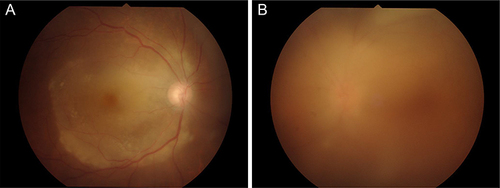 Figure 1 Acute syphilitic posterior placoid chorioretinitis observed at the first appointment. (A) Right eye of a 63-year-old man. (B) Left eye of a 68-year-old man.