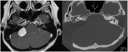 Figure 3. (A) Preoperative MRI T1 sequence with gadolinium enhancement showing tumor at the right CPA, but also contrasting small lesions along basal turn of the left cochlea and vestibule. (B) Postoperative CT scan showing electrode array in the left cochlea after subtotal petrosectomy and large craniotomy for translabyrinthine approach removal of tumor from the right.