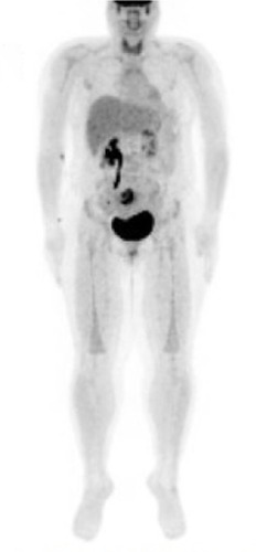 Figure 2 Surveillance PET-CT revealing uterine uptake, which led to diagnosis of stage I uterine leiomyosarcoma.