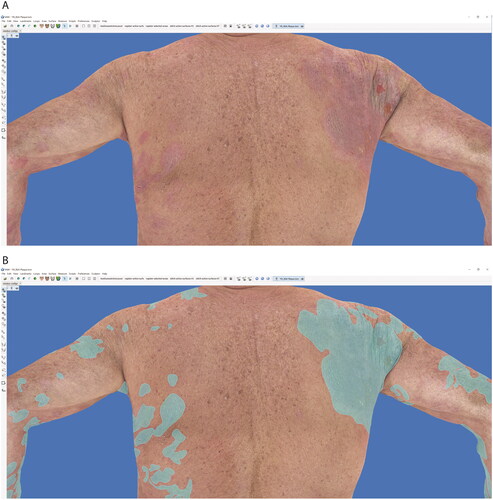 Figure 1. Sample photographs of a patient with cutaneous lymphoma in Vectra Analysis Module (VAM) software. (A) Patient with cutaneous lymphoma plaques on the back, and (B) manual demarcation of areas of plaque. Demarcated body surface area is automatically calculated in VAM and divided by the total body surface area to get the body surface area percentage affected. This process is repeated for patches and nodules, and the mSWAT score is manually calculated.