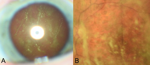 Figure 1 (A) Slit-lamp and (B) fundus photography of asteroid hyalosis.