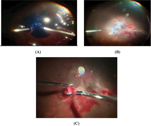 Figure 2. surgical steps of case # 5 (left eye with TRD and ERM of 51-year-old male patient suffering type 1 diabetes for14 years) in bimanual PPV group (group B): (A) Injection of the vital dye over the posterior pole. (B) Stained fibrovascular proliferations. (C) Bimanual dissection of the preretinal proliferation with intraoperative bleeding.