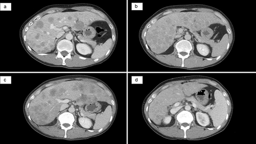 Figure 1 Abdominal CT showing multiple liver metastases. (a) Before the administration of brigatinib: detection of multiple liver lesions. (b) After 13 days of treatment with brigatinib. (c) After 25 days of treatment with lorlatinib and before the administration of ABCP: progression of multiple liver lesions. (d) After four cycles of ABCP: partial response of multiple liver lesions.