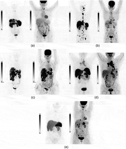 Figure 3. Illustration of Spectrum of NENs based upon Dual tracer PET-CT (68Ga-DOTATATE based SSTR PET/CT and 18F-FDG PET/CT (image display thresholds are set as per original paper [Citation29]i.e., SUVmax of FDG PET at 7 and 68Ga-DOTATATE PET at15). (a) Example of a patient of metastatic NEN with NET-PET Score: P1, in which lesions are SSTR +ve but FDG – ve. (b) Example of a patient with NET-PET Score: P2, in which lesions are both SSTR +ve and FDG +ve, but the number of lesions and their demonstrated uptake on SSTR PET >FDG-PET. (c) Example of a patient of metastatic NEN with NET-PET Score: P3, wherein lesions are both SSTR +ve and FDG +ve, and lesions and uptake on SSTR PET are nearly similar to FDG-PET. (d) Example of NET-PET Score: P4, in which lesions are both SSTR +ve and FDG +ve, but lesions and uptake on SSTR-PET. (e) Example of a patient of metastatic NEN with NET-PET Score: P5, in which lesions are SSTR-ve, but FDG+ve (Figure 3).