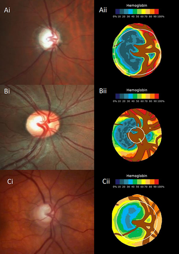 Figure 2 Example of patients with glaucoma and presumed large physiological cupping.(Ai)-retinography of the optic disc of patient with glaucoma (from Group III), (Aii)- correspondent pseudo-image estimating the amount of hemoglobin (according to the colorimetric scale shown). Correct diagnosis of glaucoma, with Glaucoma Discriminant Function index (GDF) of −81.99. (Bi)- retinography of the optic disc of patient with large physiological cupping (LPC) from Group I. (Bii)- correspondent pseudo-image estimating the amount of hemoglobin, correct diagnosis of LPC, with GDF of 31.17. (Ci)- retinography of the optic disc of patient with large physiological cupping (from Group (I). (Cii)- correspondent pseudo-images estimating the amount of hemoglobin and misdiagnosis of glaucoma with GDF −57.57.