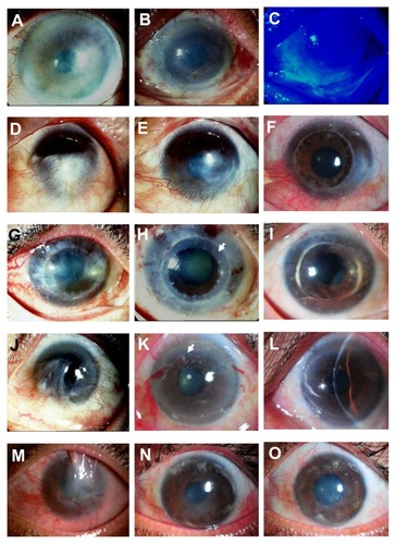 Figure 3 Representative slit-lamp photographs show a comparison of the eyes before (left column) and after (middle and right column) cultivated limbal epithelial transplantation (CLET) in the clinical success group. Patient 3 (A) undergoes auto-CLET and 1 day postoperatively the entire corneal surface is covered with transplanted cultivated corneal epithelium (B) confirmed by fluorescein staining, with no conjunctival cell contamination (C). Patient 6, who has a chemical burn (D), undergoes auto-CLET, with resultant decreased corneal neovascularization postoperatively at 10 months after CLET (E). Penetrating keratoplasty is performed for optical reasons 16 months after CLET and the corneal graft remains clear 18 months after keratoplasty (F). Patient 7 underwent a previous penetrating keratoplasty to treat cytomegalovirus keratitis (G) with severe inflammation. Two days after auto- CLET with a 360-degree annular ring of CLET (arrow), the central area is spared (H). The corneal graft has recovered and become clear with no conjunctivalization up to 34 months after CLET (I). Patient 13, with idiopathic near-total limbal stem cell deficiency bilaterally (J), undergoes allo-CLET. The corneal epithelium becomes transparent 2 weeks postoperatively (K, arrow), dissolving amniotic membrane carrier of CLET; (star), disappeared amniotic membrane) without conjunctivalization up to 19 months (L). The visual acuity has improved from 20/800 to 20/40. Patient 16, with total limbal stem cell deficiency with upper lid symblepharon and chronic inflammation secondary to chemical burn (M), is markedly improved after allo-CLET. The clinical appearance at 4 (N) and 14 (O) months postoperatively, and the visual acuity has improved to 20/200 for counting fingers half a foot away.