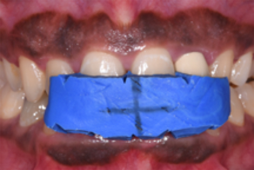 Figure 2 Standardized photos were taken with a stent and a marker to ensure the same position and angle when the images were overlayed over each other.