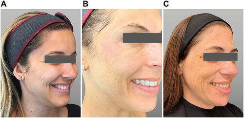 Figure 9 Types of radial cheek lines. (A) Type 1 lines: structural deficiencies. (B) Type 2 lines: skin laxity. (C) Type 3 lines: structural deficiency plus skin laxity. Courtesy of Carla Pecora, MD.