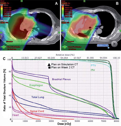 Figure 1. Proton Beam dosimetry is sensitive to lung density changes. A) Axial CT imaging of the proton beam dose distribution of the original plan for the treatment of a patient with stage III NSCLC. During the second week of a routine weekly verification resimulation CT, there was evidence of atelectasis in the right upper lobe (B). C) DVH analysis of the initial plan compared to the dosimetric alteration due to the atelectasis. Except for the brachial plexus, there was an overall increase in mean and absolute doses to all the indicated normal structures (esophagus, heart, spinal cord) and a slight under dosing of the ITV and PTV. Compared to D, panel E is an adaptive plan that was done in order to improve tumor coverage. However in order to achieve this, there had to be a compromise in the dose to normal tissues with a slightly increased doses compared to the initial plan. This is reflective in the DVH in panel F.