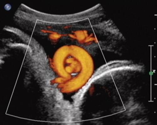 Figure 5 Sagittal imaging of the fetal neck. Fetal cranium is to the right of the image. Power Doppler imaging depicts coexisting true knot of the umbilical cord located within a nuchal cord (note the umbilical vein and two arteries seen “en face” within the almost complete umbilical cord circle). Reproduced from Sherer DM, Dalloul M, Ward K, et al. Coexisting true umbilical cord knot and nuchal cord: possible cumulative increased risk of adverseperinatal outcome. Ultrasound Obstet Gynecol. 2017;50(3):404–405. Copyright © 2016 ISUOG. Published by John Wiley & Sons Ltd.Citation34