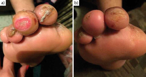 Figure 3. Chronological evolution of the ulcer on the third toe of the right foot. Initial appearance (a), ulcer at 30 days (b).