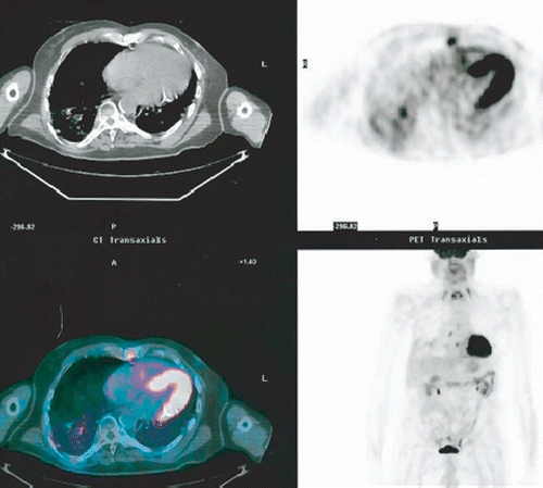 Figure 3. Same patient 11 months later. Note the hypermetabolic area adjacent to the area treated. SUV 5.6. Recurrent tumor is visible at the edge of the PTV.