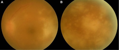 Figure 1 Fundus photographs of the left eye of the patient upon presentation at our hospital.