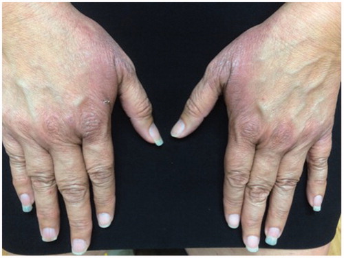 Figure 1. Presence of erythematous-violaceous scaly plaques on the dorsal hands characteristic of PATEO.
