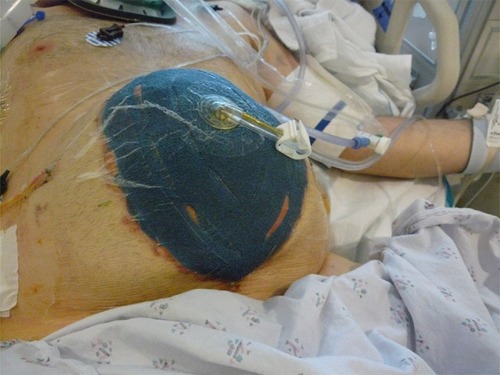 Figure 3 A clinical image of a patient with aortic injury subjected to damage control laparotomy with temporary abdominal closure using negative pressure wound therapy (NPWT).