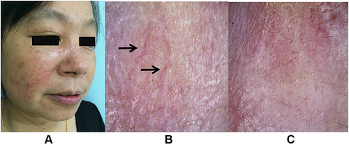 Figure 3 Six months of treatment: the lesions had significantly resolved (A); dermoscopy revealed linear and dendritic vessels ((B), dark arrow) on a pink background, and yellow dots have disappeared; vellus hair had returned (C).