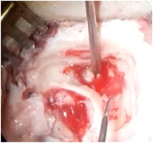 Figure 5. Removal of scaly lamellar tissue during intraoperative period.