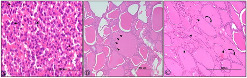 Figure 3. BTV-1, 6 ml (5.5 log10 TCID50/ml) inoculated by I/D and IV routes in sheep at 60th gestation day. H&E section, thyroid sections: (A) at 7th DPI, hyperplasia of the parafollicular cells (C-cells) with few undergoing apoptosis (asterisk), ×400; (B) at 30th DPI, enlarged follicles with flattened epithelium (arrowhead) and with dark to lightly stained collide devoid of reabsorption vacuoles, ×200 and (C) at 30th DPI, showing elongated follicle filled (curved arrow) with the colloid with flattened follicular epithelial cells (arrowhead) on 45th DPI, H&E, ×200.