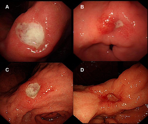 Figure 1 The peri-ulcerative mucosal inflammation appearance refers to the degree of mucosal inflammation within 2 cm of the ulcer edge. (A) The mucosa is smooth and soft—with slight hyperemia and edema and without erosion and thickened gastric folds. (B) The mucosa is obviously hyperemic and edematous—with fibrinoid exudate and without thickened gastric folds and erosion. (C) The mucosa is severely hyperemic, edematous, and brittle—with fibrinoid exudate and thickened gastric folds and without erosion. (D) The mucosa is obviously hyperemic, edematous, and brittle—with fibrinoid exudate, erosion, and thickened gastric folds.