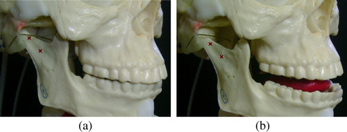 Figure 6. AnTon's temporomandibular joints (TMJ) produce a natural forward sliding motion during jaw opening. The markers show that in (b), the condyle has clearly moved forward within the joint capsule.